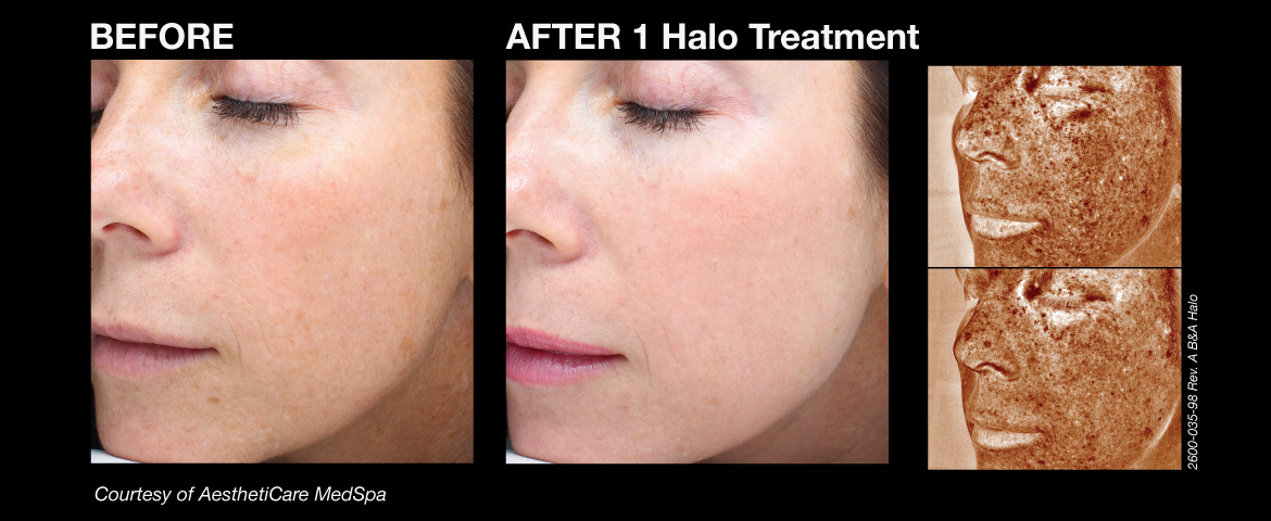 halo therapy halo therapy